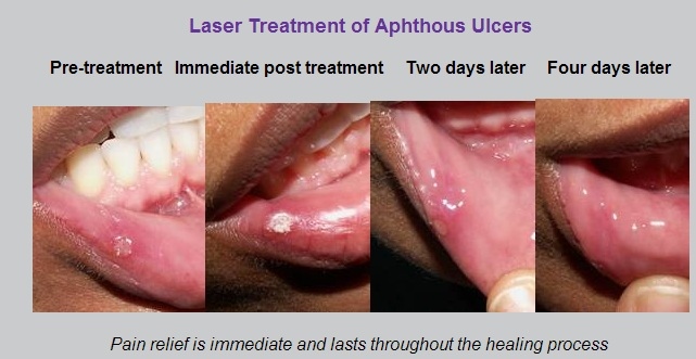 treatment for stomatitis