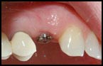 dental implants