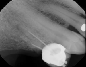 dental implant bridge