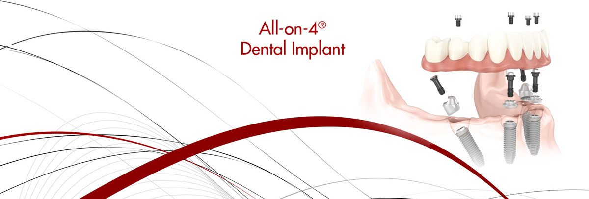 Philadelphia All-on-4 Dental Implants