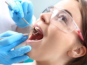 Composite Fillings