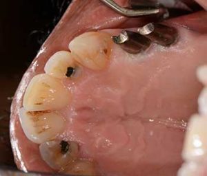 dental implant custom abutments