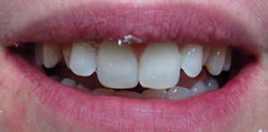 Before bridge restoration with two canine baby teeth