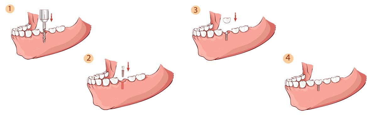  Philadelphia The Dental Implant Procedure