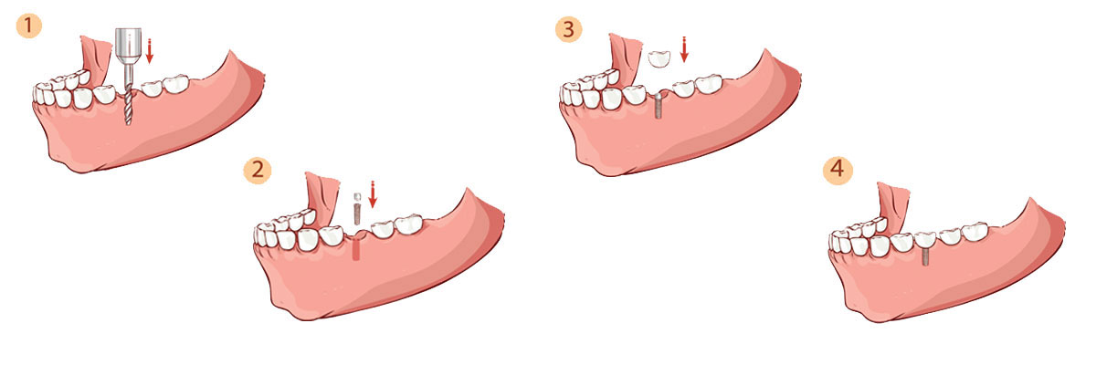  Philadelphia Dental Implant Restoration