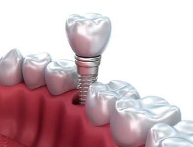 Dental Implant