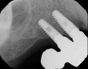 dental implants cantilever