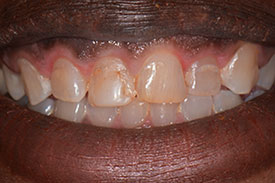 A week after gingivectomy procedure