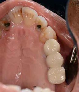 porcelain implant bridge