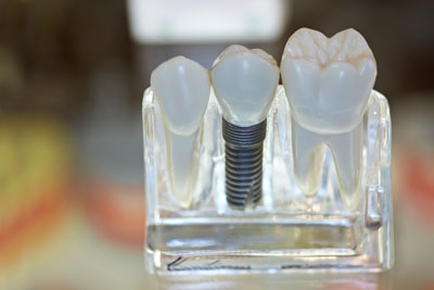 Implant Supported Dentistry