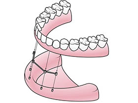 Implant Supported Dentures