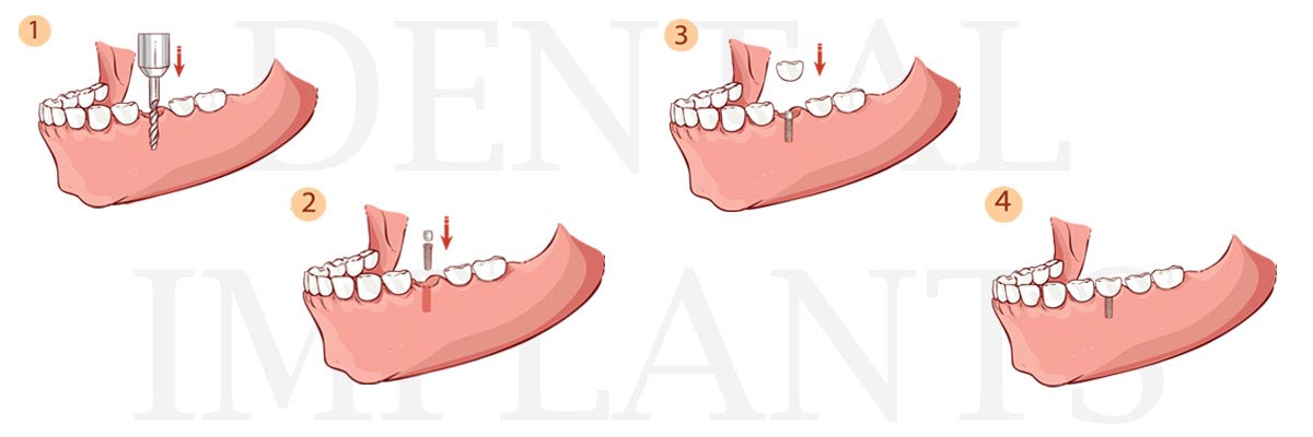 Philadelphia The Difference Between Dental Implants and Mini Dental Implants
