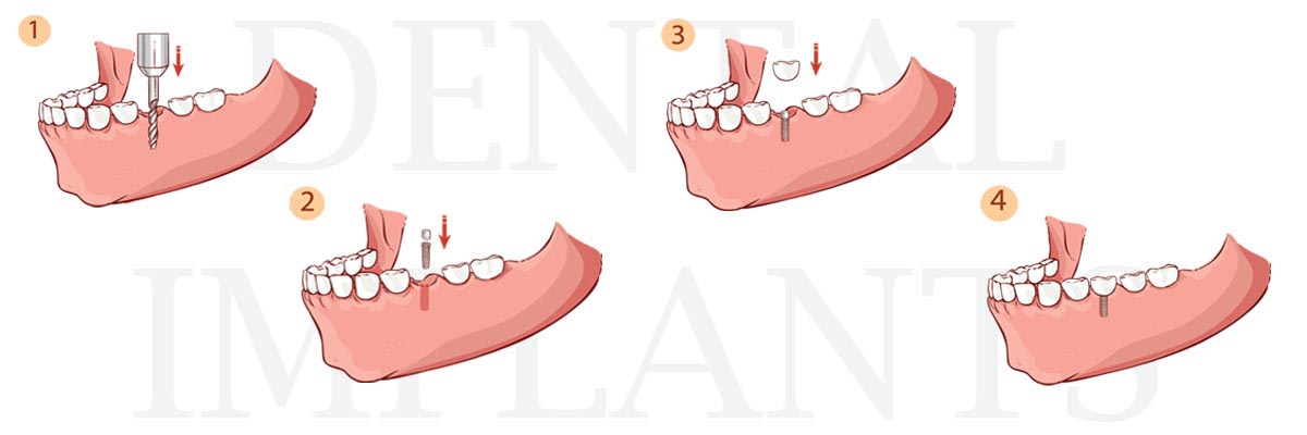  Philadelphia The Difference Between Dental Implants and Mini Dental Implants