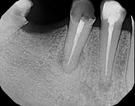 laser-root-canal-before