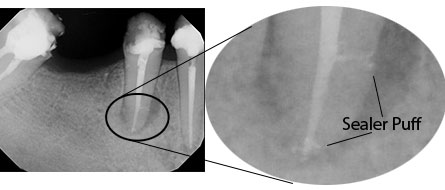 laser-root-canal-post