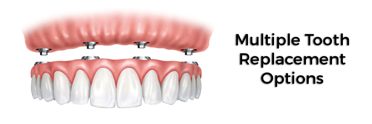  Philadelphia Multiple Teeth Replacement Options