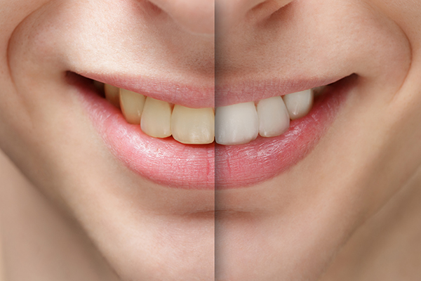Teeth Whitening Teeth Whitening