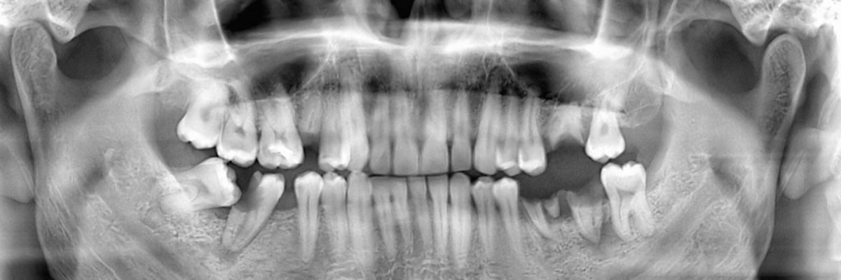 Philadelphia Wisdom Teeth Extraction