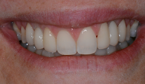 After zirconia bridge restoration on upper left and upper right